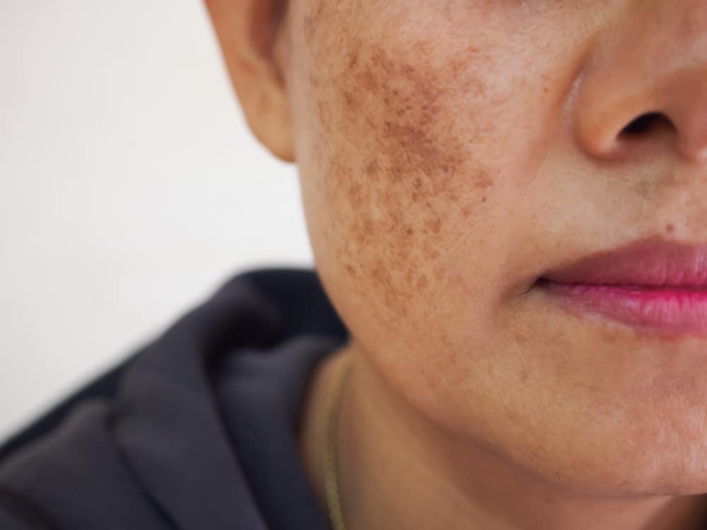 Melasma Treatment in Victoria, TX